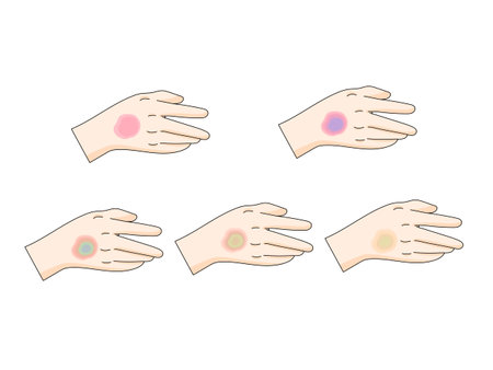 bruise stages diagram schematic vector illustration. Medical science educational illustrationのイラスト素材