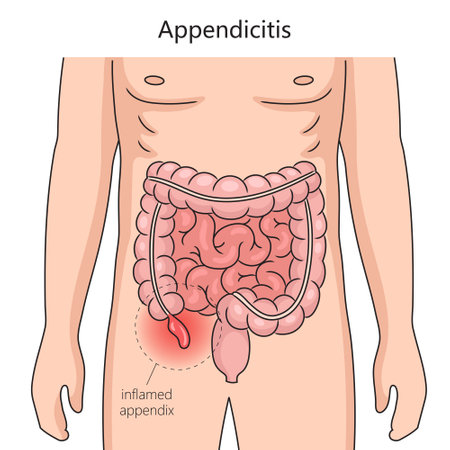 Appendicitis inflammation of the appendix diagram schematic vector illustration. Medical science educational illustrationのイラスト素材