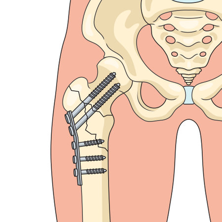 Internal fixation operation in orthopedics surgical repairing bone diagram schematic vector illustration. Medical science educational illustrationのイラスト素材