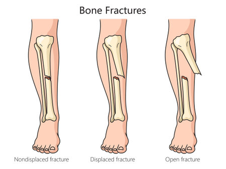 Types of bone fractures diagram schematic vector illustration. Medical science educational illustrationのイラスト素材