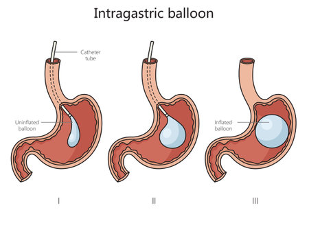 intragastric stomach balloon structure diagram hand drawn schematic vector illustration. Medical science educational illustrationのイラスト素材