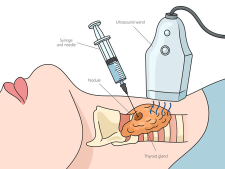 Ultrasound guided thyroid puncture structure diagram hand drawn schematic raster illustration. Medical science educational illustrationの写真素材