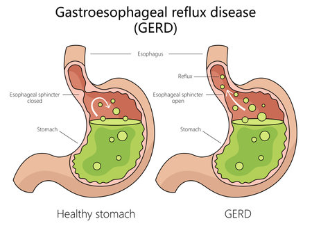 Human gastroesophageal reflux disease structure diagram hand drawn schematic raster illustration. Medical science educational illustrationの写真素材