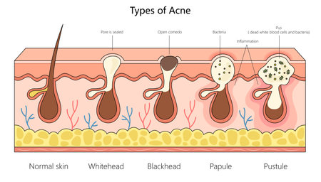 various acne types, from normal skin to inflamed pustules, for dermatological studies structure diagram hand drawn schematic vector illustration. Medical science educational illustrationのイラスト素材