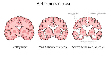 progression of Alzheimer disease, comparing a healthy brain to those with mild and severe Alzheimer...