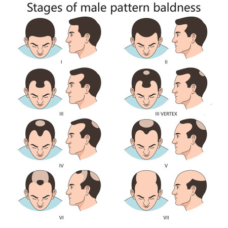 Stages of male pattern baldness, showing progressive hair loss from stage I to stage VII diagram hand drawn schematic vector illustration. Medical science educational illustrationのイラスト素材