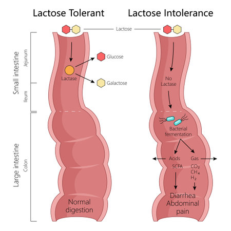 lactose tolerance and intolerance, normal digestion with lactase and symptoms from bacterial fermentation diagram hand drawn schematic vector illustration. Medical science educational illustrationのイラスト素材