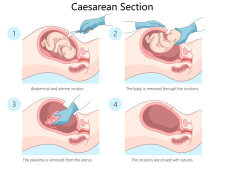 caesarean section procedure showing steps. incision, baby removal, placenta removal, suturing of incisions diagram hand drawn schematic vector illustration. Medical science educational illustrationのイラスト素材
