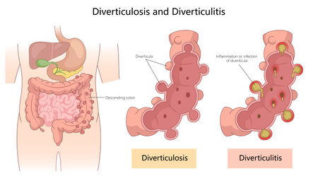 Diverticulosis and Diverticulitis diagram medicalのイラスト素材