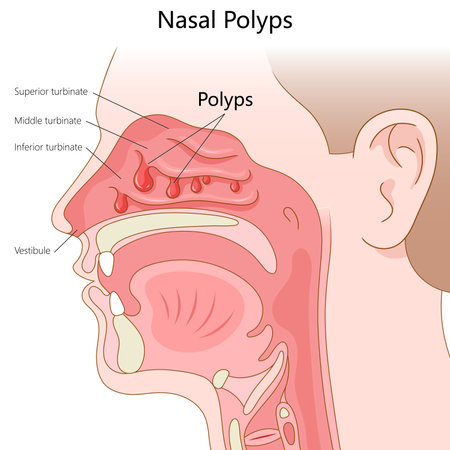 nasal polyps in the sinus cavity, labeled with turbinates and nasal anatomy for educational purposes diagram hand drawn schematic raster illustration. Medical science educational illustrationの写真素材