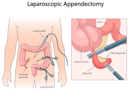 Laparoscopic appendectomy, instruments used and the removal of an inflamed appendix from the large intestine diagram hand drawn schematic raster illustration. Medical science educational illustrationの写真素材