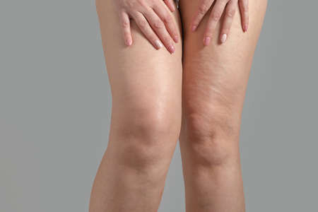 stretch marks, cellulite and varicose veins on a woman's legs