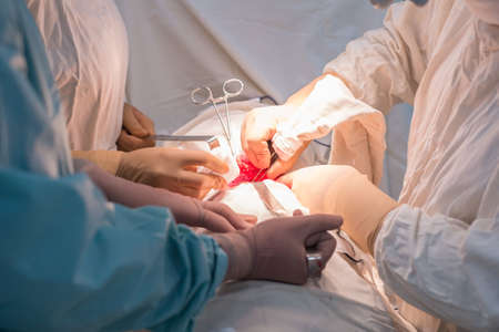 Doctors - children's surgeons, in a sterile operating room, perform a kidney operation. Surgeon's hands holding surgical instruments, manipulateの写真素材