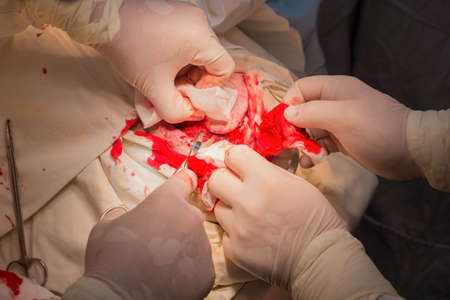 view from above. A close-up of the stages of a neurosurgical operation in a child, the installation of a titanium plate in the skull after an accident. Neurosurgical treatment of onology in children. Skull injury, operation. The work of pediatric neurosurgeons on craniotomyの写真素材