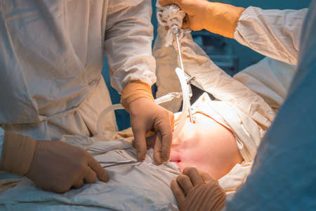 Close up of laparoscopic surgery in a sterile operating room. Percutaneous suturing of the inner ring PIRS. Surgeons and his assistant perform surgery on a child with an inguinal herniaの写真素材