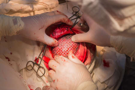 top view, stages of neurosurgical surgery for installing a titanium plate in the patients skull....