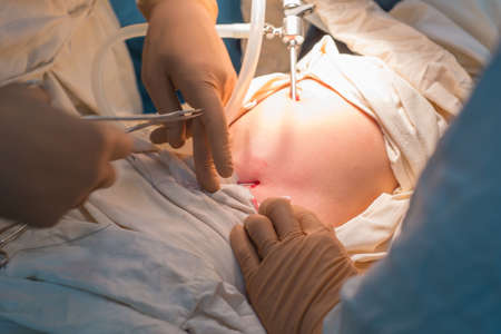 close-up hands of pediatric surgeons perform surgery using laparoscopic ports for endoscopic surgery. In a sterile operating room. Pediatric surgery, treatment of inguinal hernia in children by PIRSの写真素材