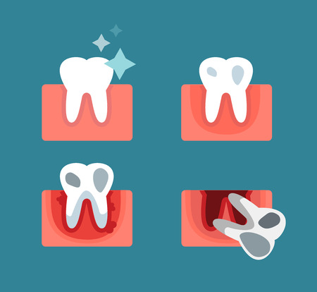 Periodontal disease stage steps vector illustration. Dental tooth problems vector concept. Toothache, tooth dead, bad tooth care. Doctors dentists professional illustration. Medical dental tooth disease, oral problemsのイラスト素材
