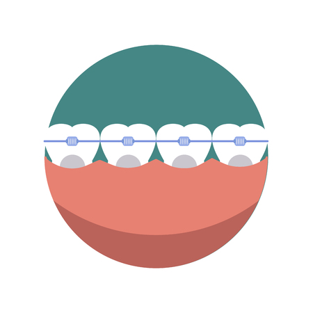 Braces dental smile mouth and beauty health teeth braces. Braces dentistry bracket and metal orthodontic braces. Tooth stomatology casual oral braces. Teeth dental mouth with care braces vector.のイラスト素材