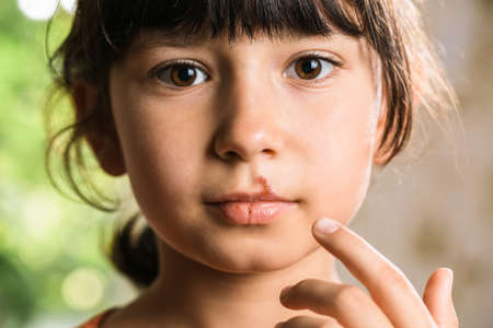 Herpes on upper lip of a little girl. Wound on the face of a schoolgirl. Inflammation of the lip. Child with cold sores on her lip. Beautiful lips infected herpes virus.の写真素材