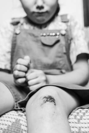 little girl hurt her knee. a scratched knee. brave girl.black and white.の写真素材