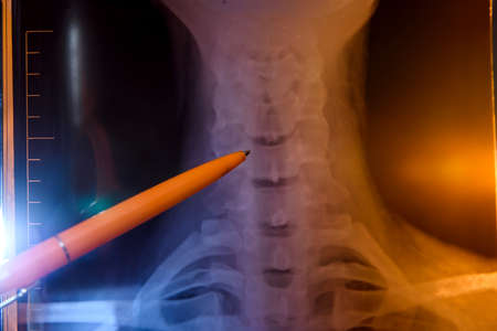 X-ray of a patient with pen close up