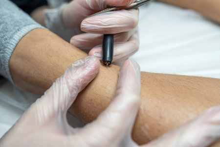 Doctor doing electroepilation procedure for removal of unwanted hair from woman's legs at medical cabinet. healthy lifestyleの写真素材