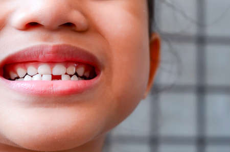 Closeup view kid coated teeth problem. Selective focus.