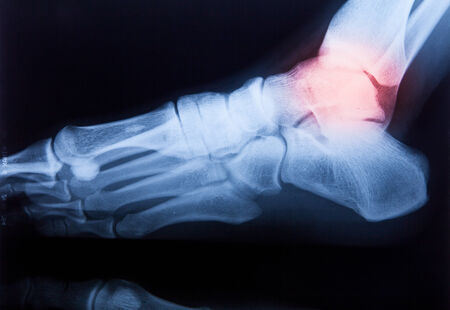 Ankle feet & knee joint X-ray human photo film