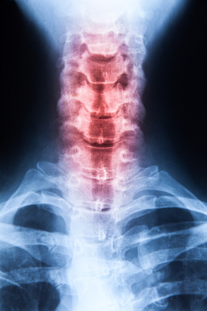 X ray MRI - Image of Spinal Column Neck pain and Skull Head Stressの写真素材