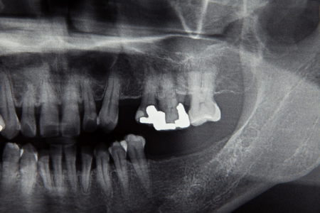 Dental X ray human film for dentist