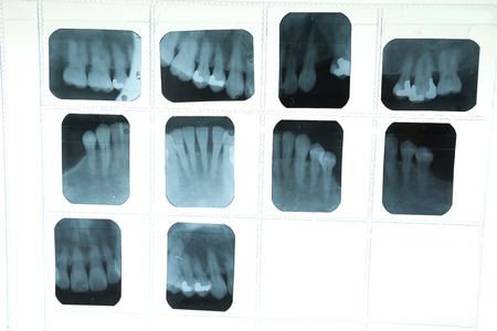 Panoramic dental X-Ray film for dentist
