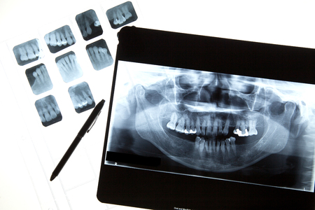 Panoramic dental X-Ray film for dentistの写真素材