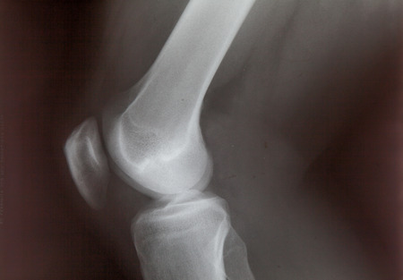 Ankle feet & knee joint X-ray human photo film