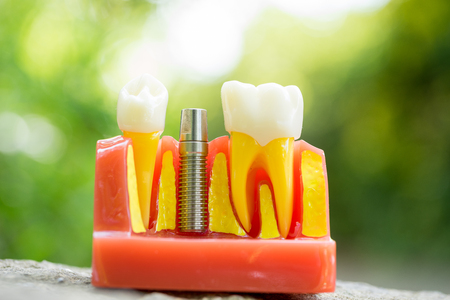 Set of Dentist's equipment tools, denture showing implant