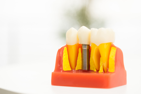 Set of Dentist's equipment tools, denture showing implantの写真素材