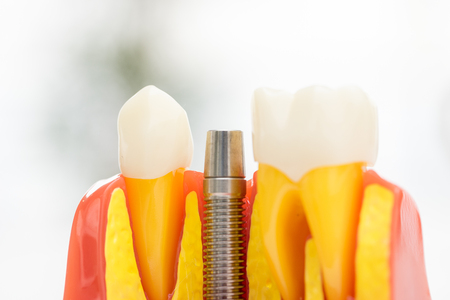 Set of Dentist's equipment tools, denture showing implantの写真素材