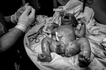 newborn baby with caesarean section surgery, black and white photosの写真素材