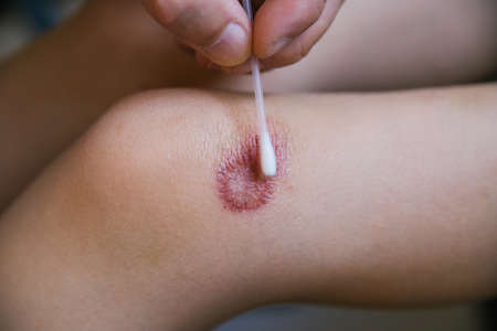 A man's hand treats the damaged skin on the child's leg with an antiseptic solution. Dry skin and irritation. Allergic reactions.An abrasion and a scratch on the knee.First aid at home.の写真素材
