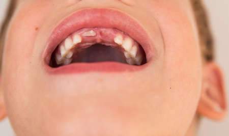 The smile of a child who has lost a baby tooth. Care for children's teeth. Dental hygiene and treatment at the dentist.の写真素材