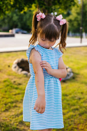 A little girl walks in the park in the summer. The child is bitten by mosquitoes. A girl combs insect bites on her hands. Redness on the skin and itching.の写真素材