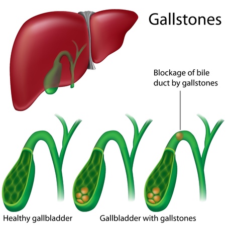 Gallstones, eps8のイラスト素材