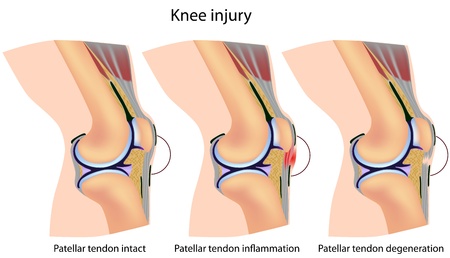 Jumper's knee anatomy, eps8のイラスト素材