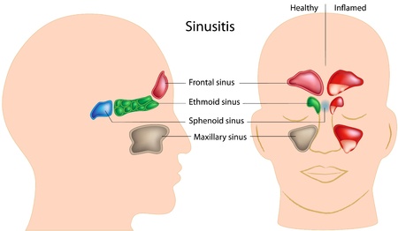 Sinusitis, eps8