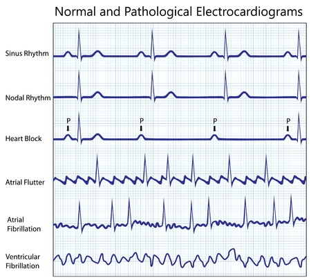 Normal and diseased ecg collection, eps8