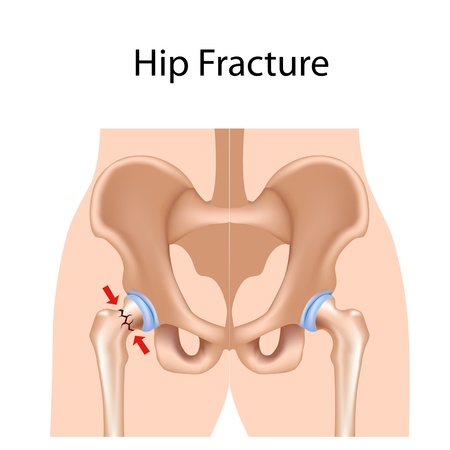 Hip fracture, eps8のイラスト素材