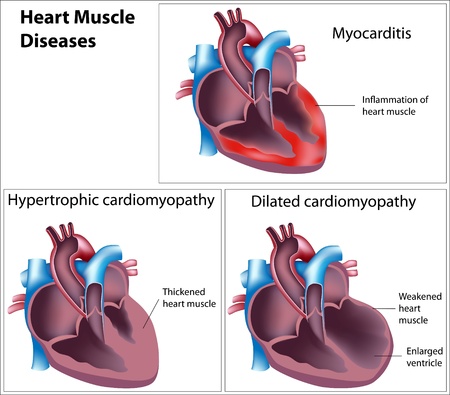 Diseases of heart muscle, eps8のイラスト素材
