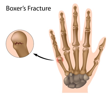 Boxer fracture, eps8のイラスト素材