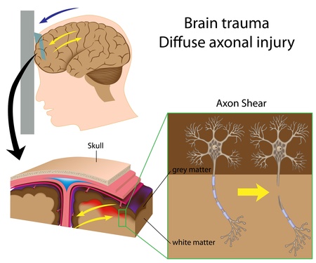 Brain trauma with axon shearのイラスト素材