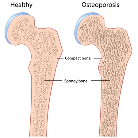 Osteoporosis of hip bone (femur)のイラスト素材